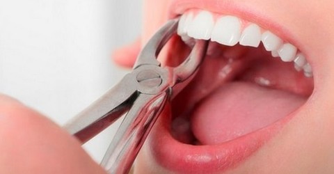 Удаление зуба, простое